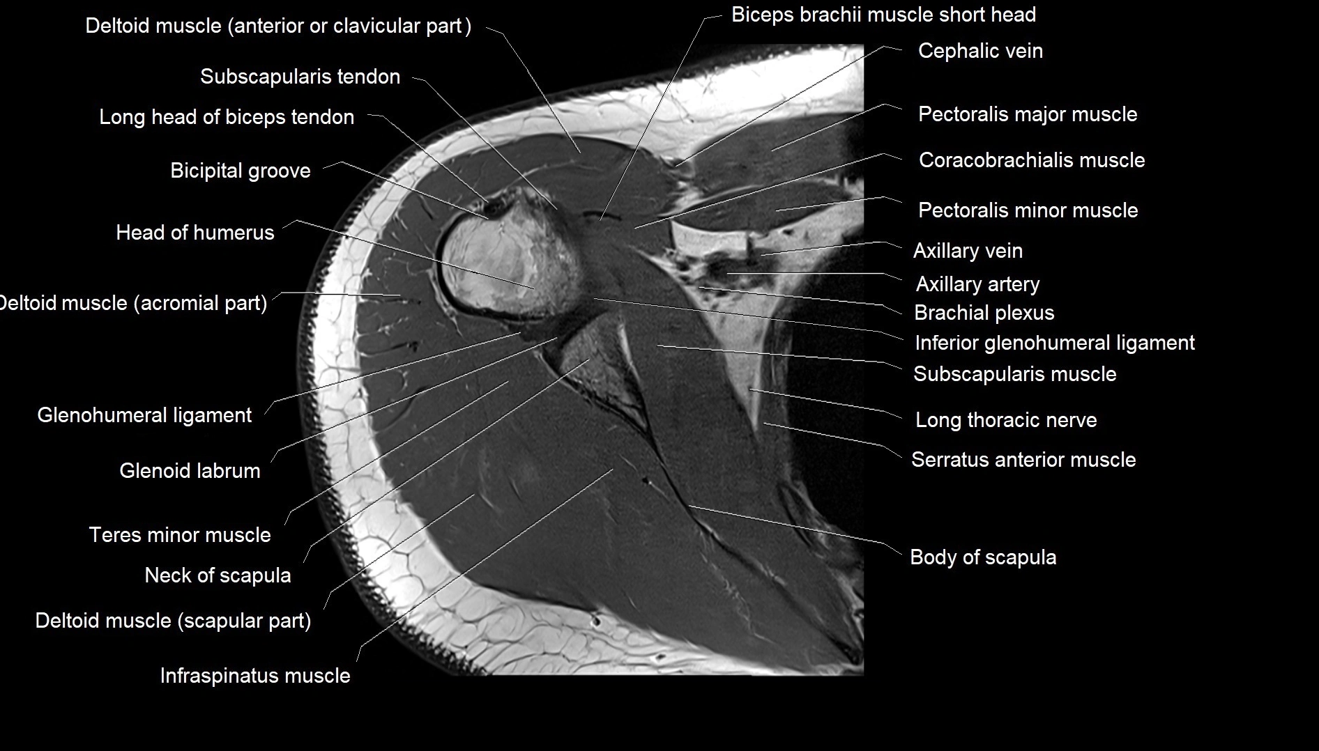Shoulder cross sectional anatomy MRI 3T axial image 24.webp